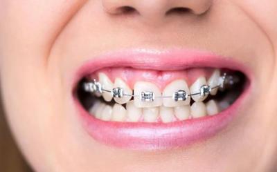 孩子多大做牙齿矫正合适_20多矫正牙齿合适吗_牙齿矫正好吗