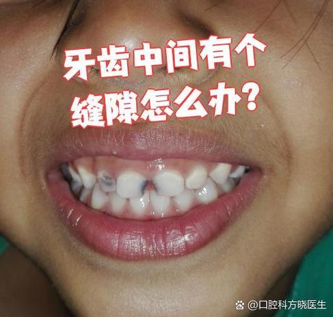 广州门牙有缝怎么矫正？这几种方法亲测有效