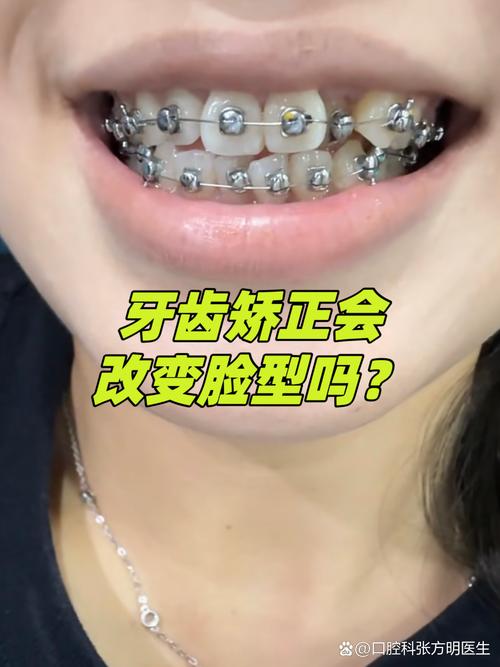 龅牙矫正完后会不会反弹_龅牙矫正后_18岁龅牙可以矫正回来吗