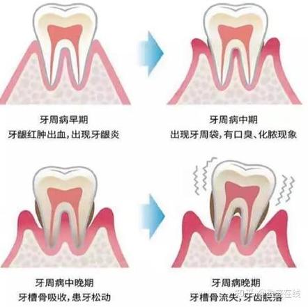 广州三十岁还能整牙吗？成人牙齿矫正必知真相