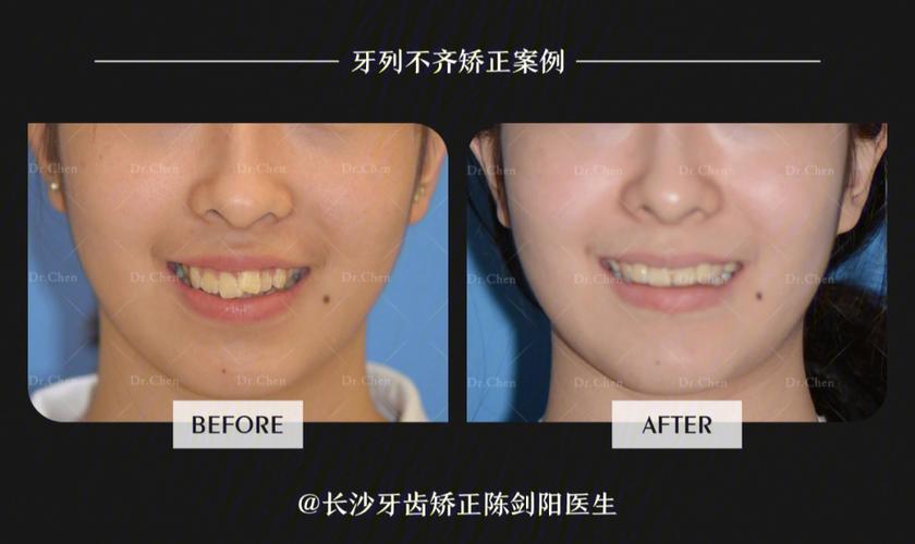 广州拔门牙矫正牙齿会松动吗？正畸医生说出大实话