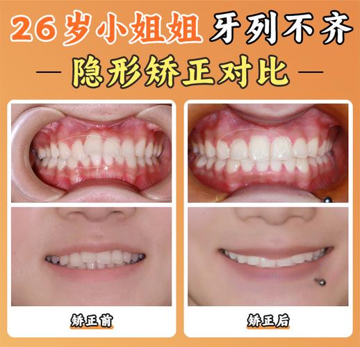 广州北京舌侧矫正靠谱吗？价格/医院/医生全揭秘