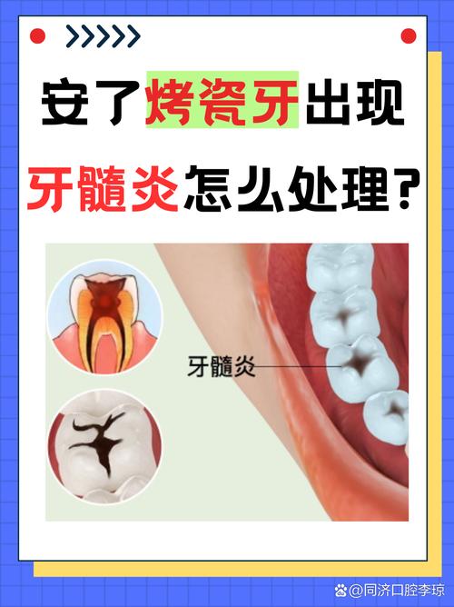 广州牙医良心忠告：做烤瓷牙前这两点不注意，当心毁了整口牙
