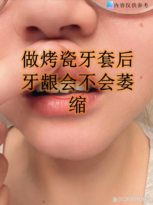 一个牙医的良心忠告烤瓷牙_牙科诊所烤瓷牙一般多少钱_良心医生建议做烤瓷牙