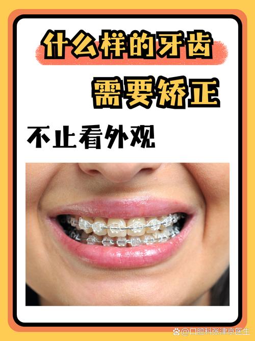 广州45岁矫正牙齿还来得及吗？过来人分享3年真实经历，成人正畸必看