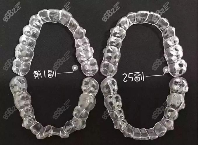 广州深圳隐适美矫正费用全公开 花多少钱心里有数