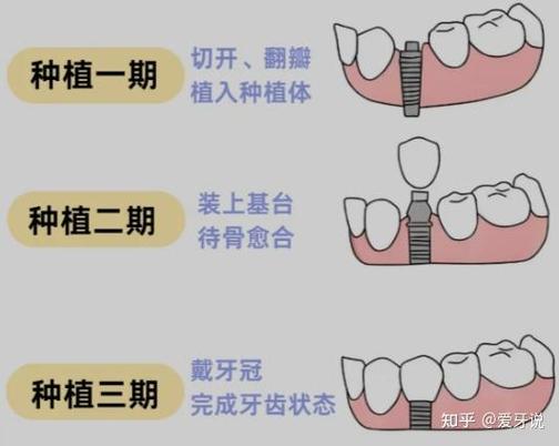 广州杭州种植牙骨粉贵不贵？要补多少？
