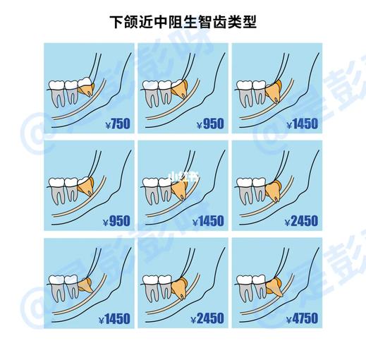 广州杭州口腔医院拔牙要花多少钱？怎么选才不踩坑？