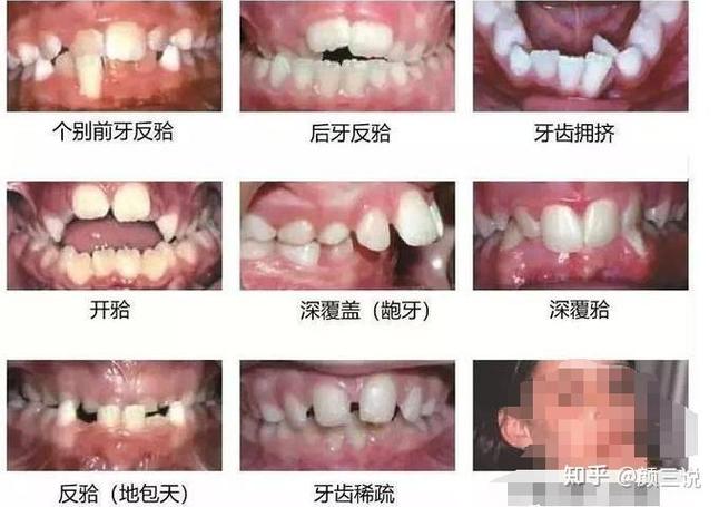 广州青岛儿童几岁做正畸最好？多少钱？