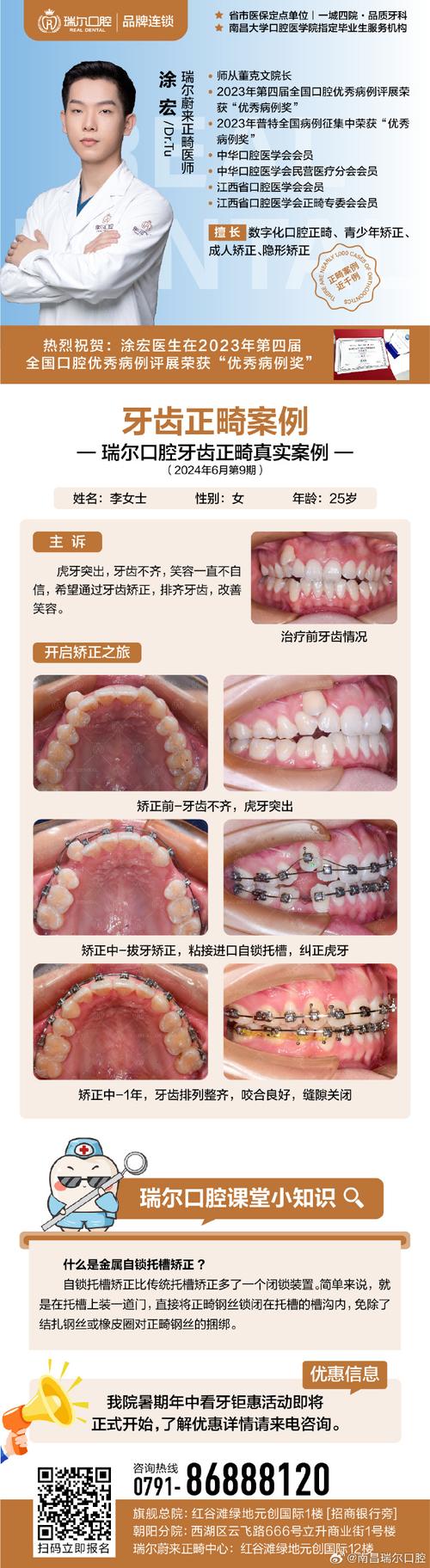 广州成人龅牙矫正选医院还是诊所？关键看医生资质和案例对比