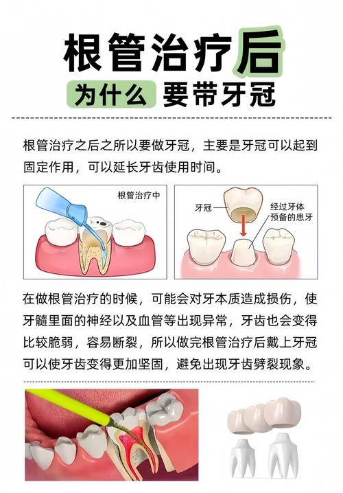 广州根管治疗补牙到底怎么回事？医生详解步骤和必要性