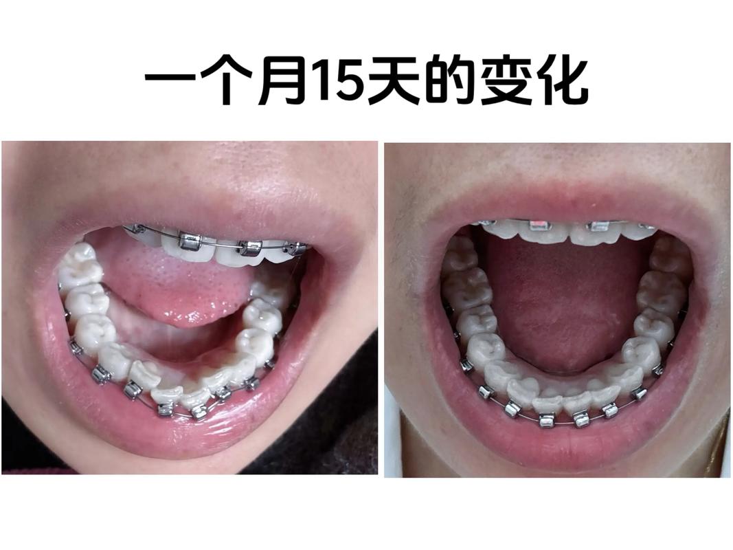 广州深圳30岁矫正牙齿还来得及吗