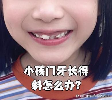 广州深圳孩子换牙门牙歪斜怎么办？专业干预指南与避坑建议