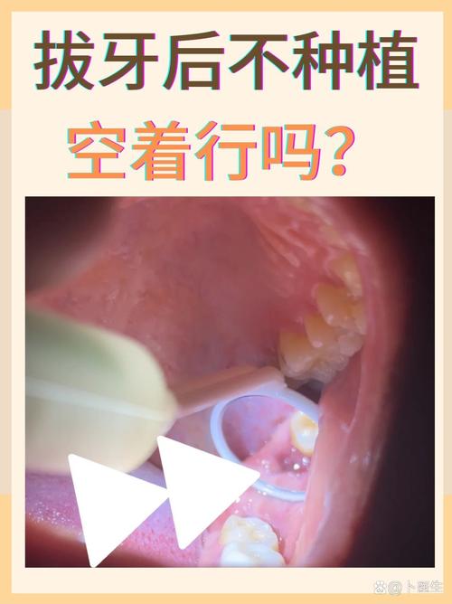 广州成人拔牙后必须种牙吗？不种牙的后果，医生告诉你真相