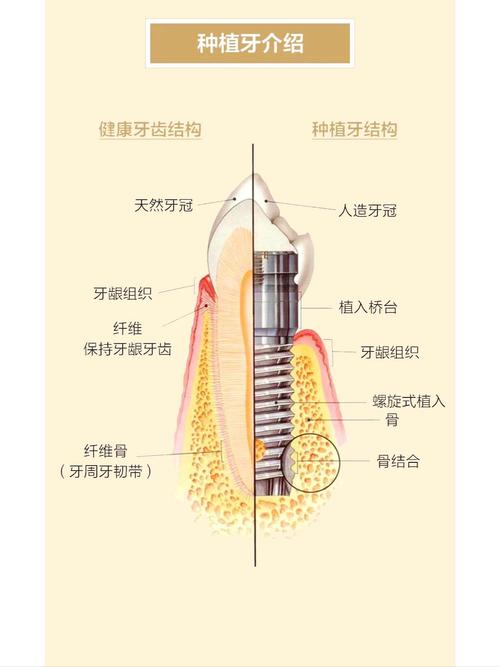 广州什么叫种植牙齿 一篇讲清原理过程