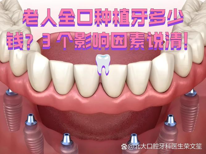 广州沙井全口种植多少钱？要种几颗？一次说清