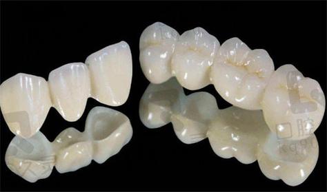 广州深圳全瓷牙哪家牙科好 真实经验分享