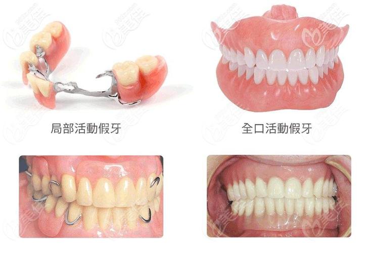 广州洛阳种牙多少钱？2026年2500-4700元到底靠不靠谱