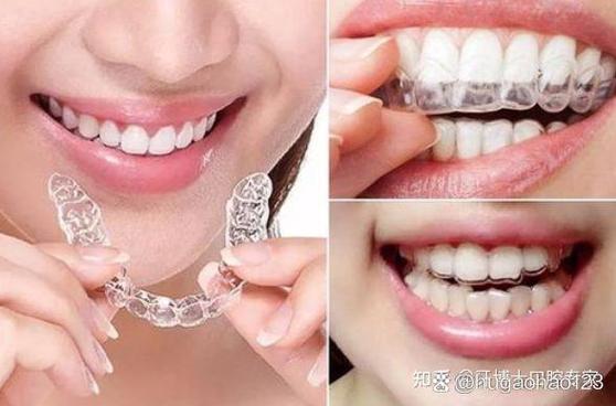 隐适美和时代天使怎么选_时代天使与隐适美_隐适美和时代天使佩戴感觉