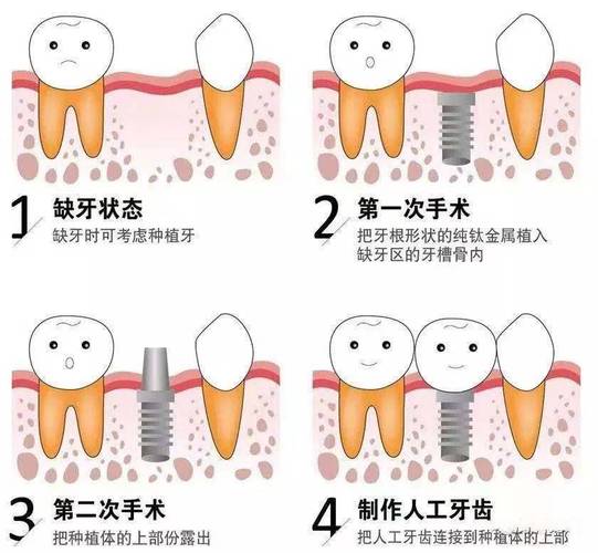 广州上海种植牙全过程揭秘：从挂号到戴牙多久？