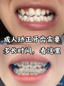 牙齿矫正可以医保报销吗_牙齿矫正可以只矫正几颗吗_30岁可以矫正牙齿么