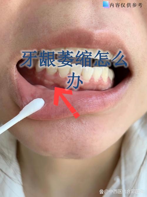 广州缺牙不补的严重后果：邻牙倾斜松动，对牙伸长，牙槽骨萎缩