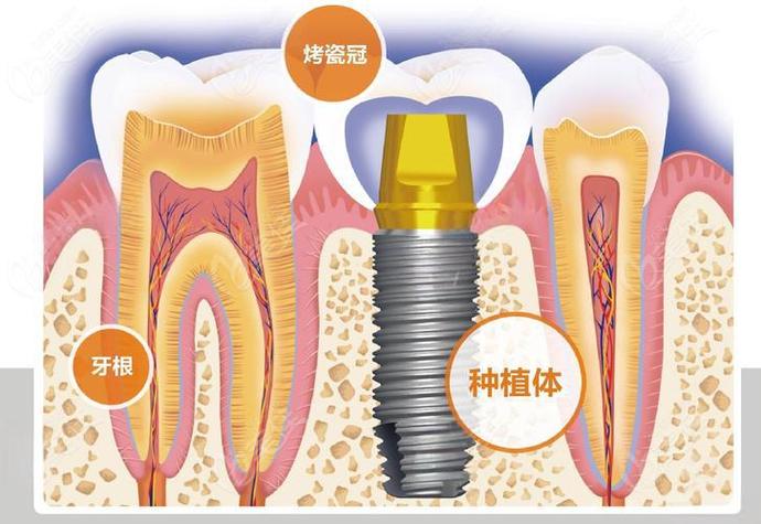 广州赤峰种牙费用详解：从预算到效果，给您的实惠指南