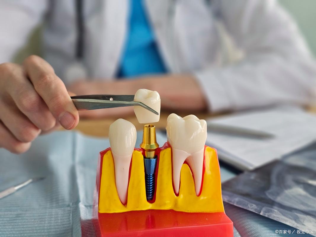 广州瑞士Straumann种植牙价格全解析：种一颗牙到底要花多少钱？