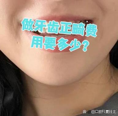 广州深圳福田青少年钢丝矫正牙齿要花多少钱