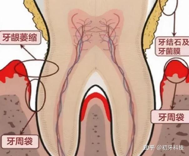 广州贵阳种植牙2026年单颗3500到5500元贵吗