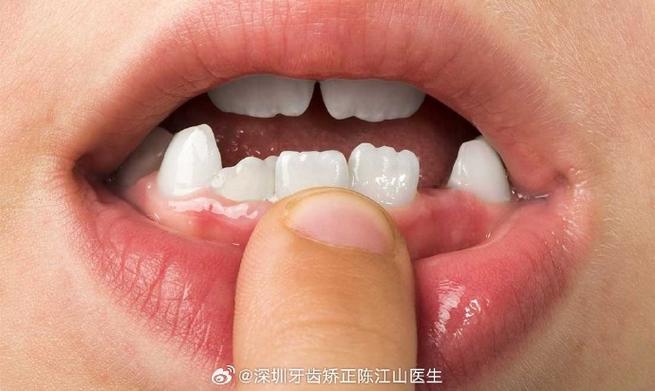 广州小孩牙齿长成锯齿状，到底严重不严重？