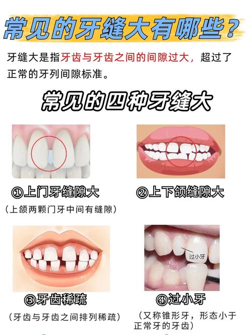 广州矫正牙齿门牙缝隙变大了？医生告诉你正常吗咋应对