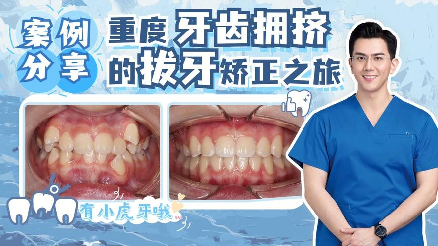 广州告别“虎牙”尴尬，快速矫正重塑自信笑容