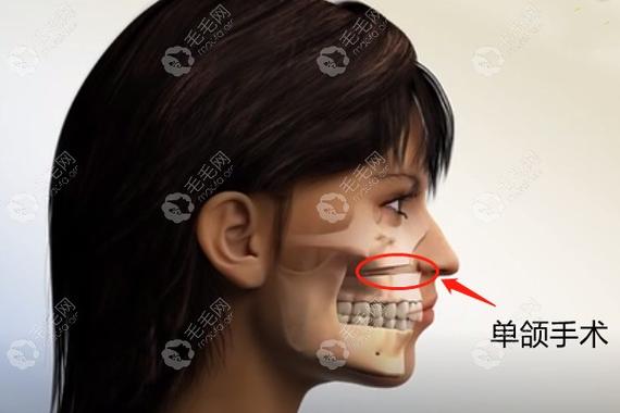 牙齿矫正大概要花费多少钱成人_深圳成人骨性龅牙矫正费用_深圳成人牙齿矫正哪家医院好