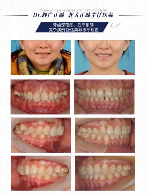 广州30岁后矫正深覆合？成人正畸完全可行