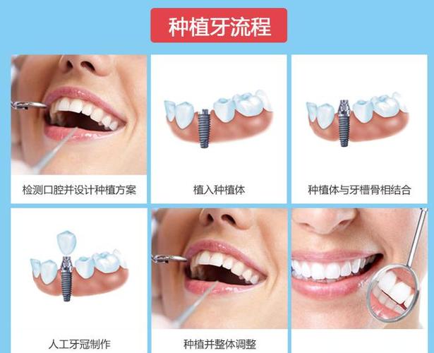 广州深圳罗湖骨量不足全口种牙多少钱?费用明细来了