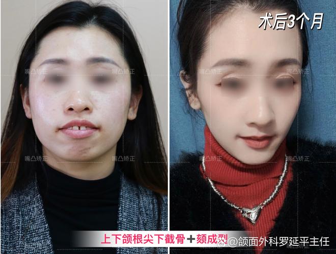 广州凸嘴矫正真能靠整牙改变？来看真实效果