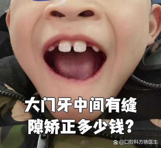 矫正牙费用需要多少钱_矫正牙需要多少费用_矫正牙齿一般要花多少