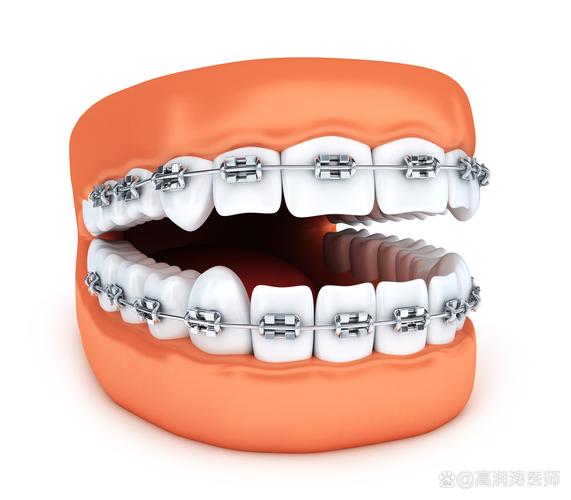 成人矫正龅牙的原理_成人能矫正龅牙吗_成人矫正龅牙还有效果吗
