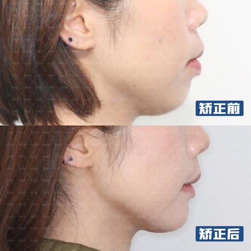 成人矫正龅牙的原理_成人能矫正龅牙吗_成人矫正龅牙还有效果吗