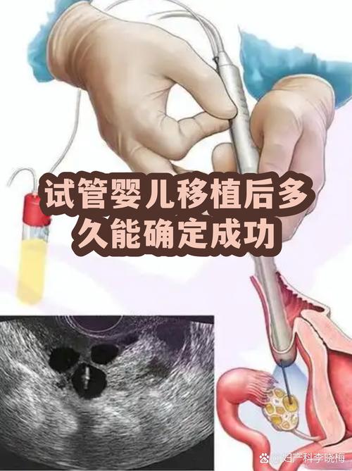 广州一代试管婴儿能成功吗 看完心里有底