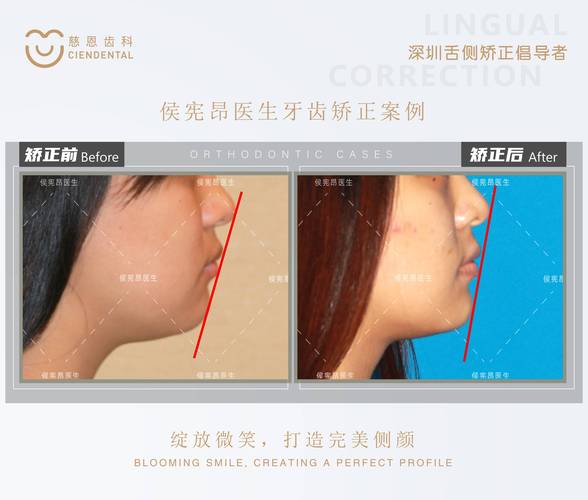 广州为什么24岁做牙齿矫正效果更好