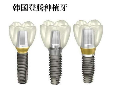广州株洲种牙哪家强？公立医院性价比之选