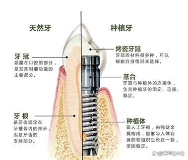 广州深圳缺牙修复:镶牙与种植牙到底哪个更省钱?
