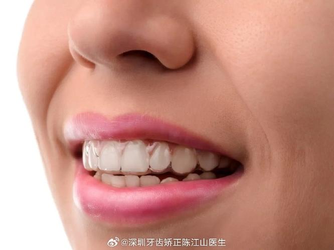广州成年人矫正牙齿多久能好？揭秘快速整牙的真相与代价