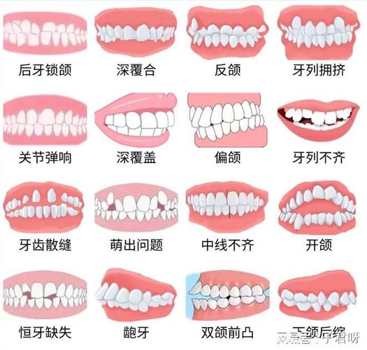 广州儿童牙齿矫正一般价格多少？带娃整牙到底花几万