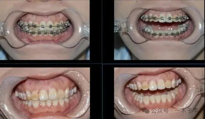 广州30岁矫正牙齿有什么危害？把坑说透了再决定