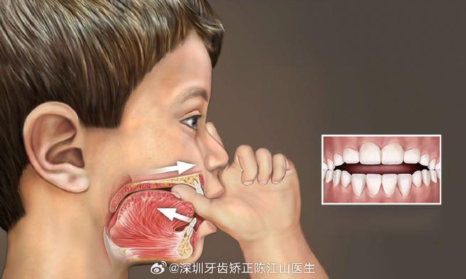 广州深圳孩子地包天几岁治最好？牙医揭秘黄金期
