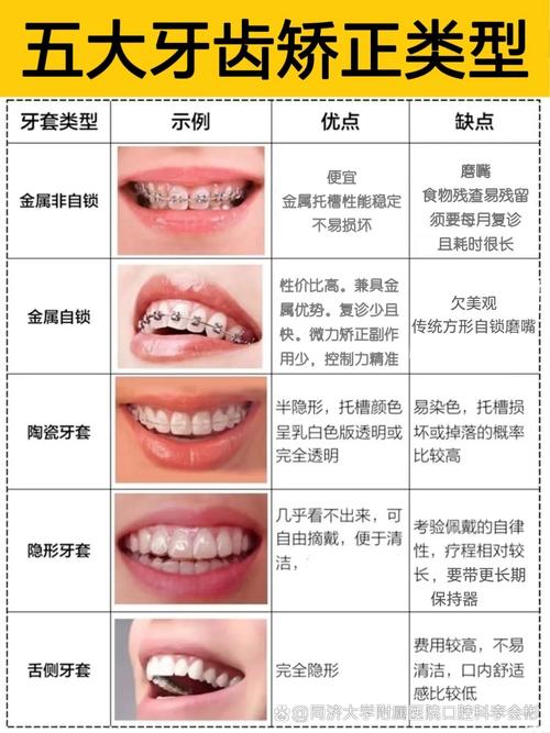 广州21岁矫正牙齿不晚！成人正畸时长与效果解析