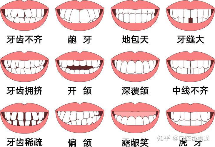 广州25岁矫正牙齿还来得及吗真实经历分享